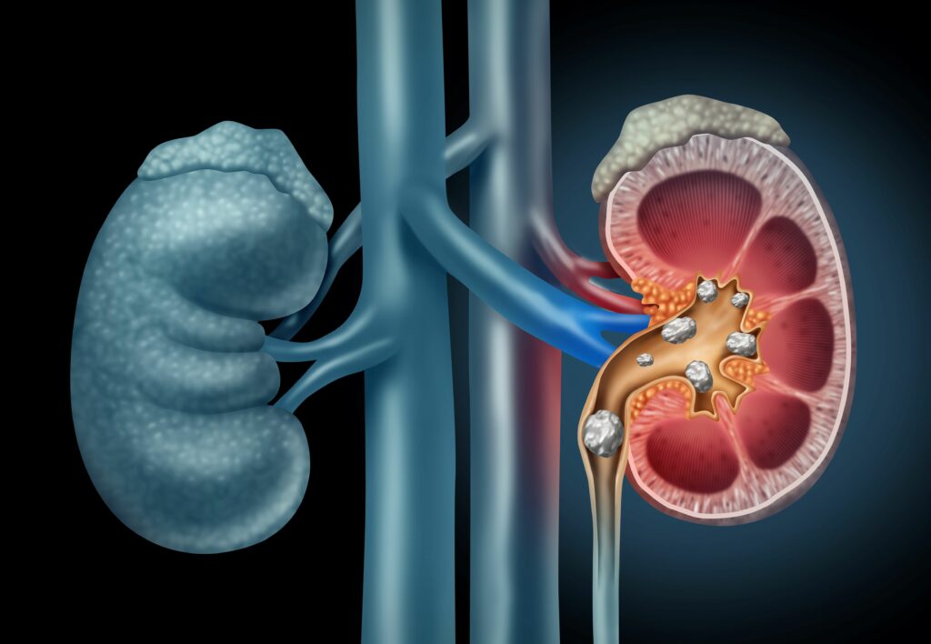 Las piedras en el riñón pueden llegar a provocar una obstrucción en la vía urinaria.