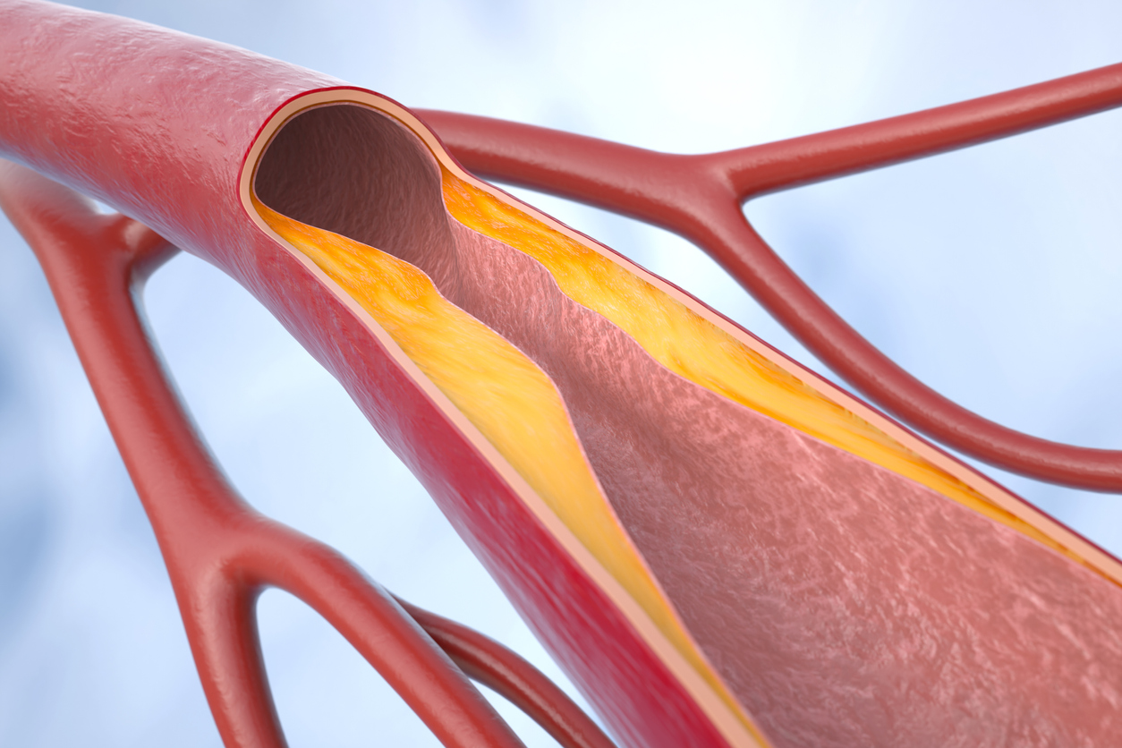 El score de calcio permite conocer la acumulación de placa en las arterias.